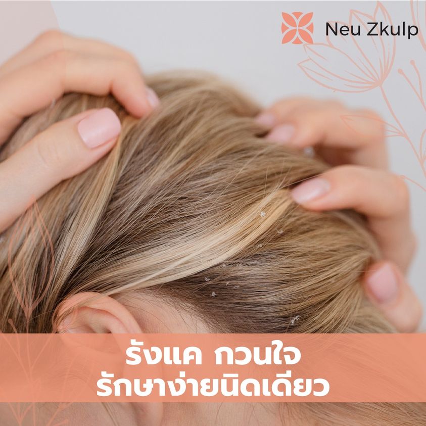 รังแค รักษาง่ายนิดเดียว